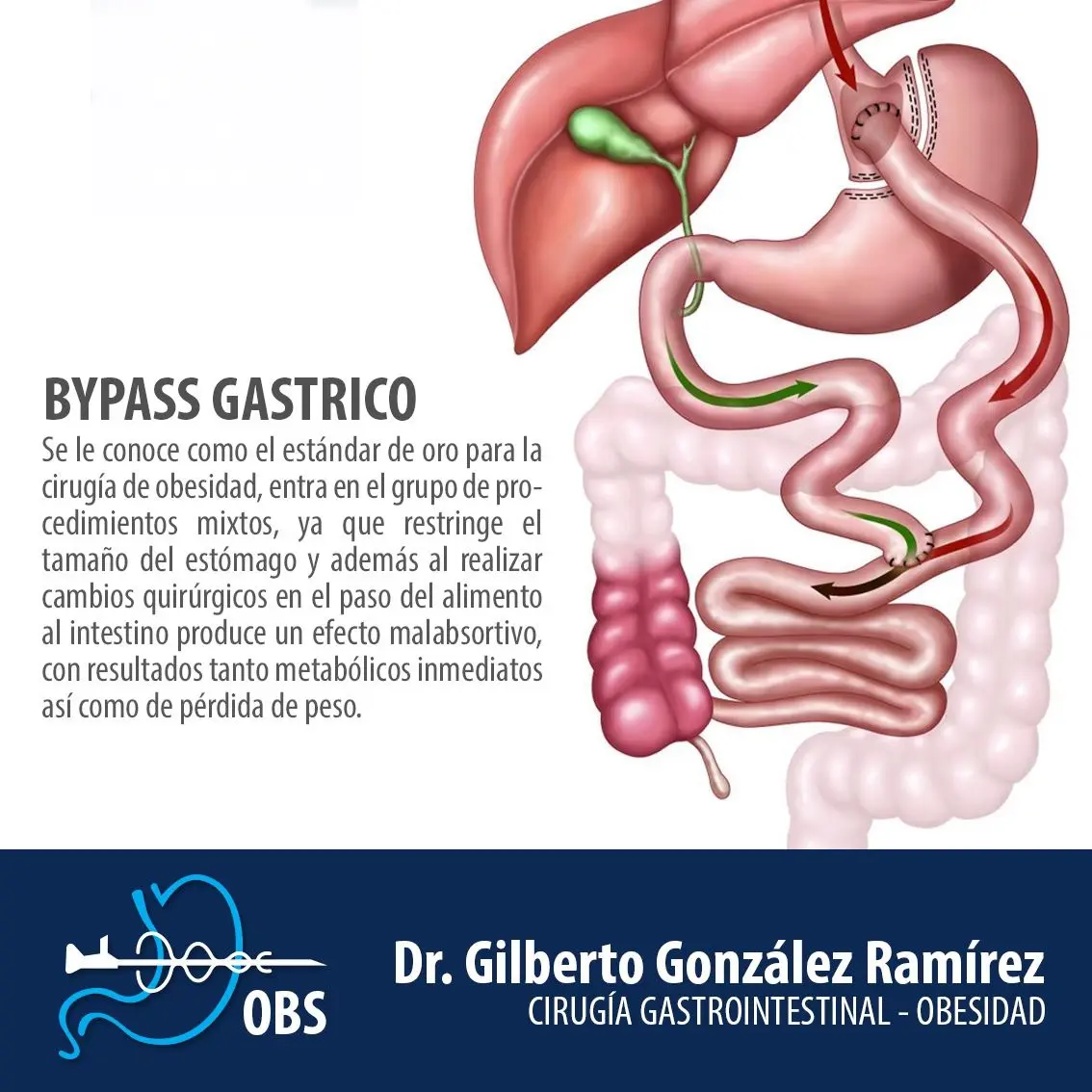 Diagrama del bypass gástrico
