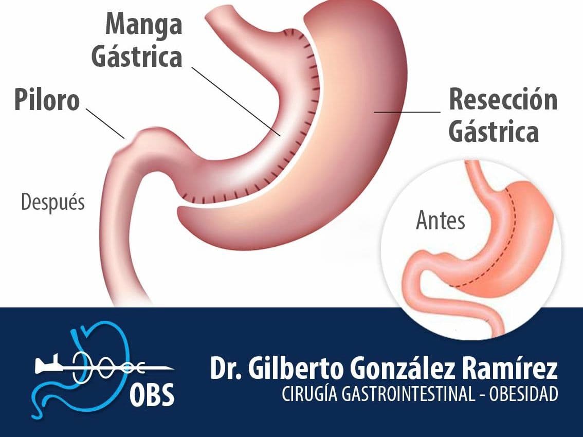 Diagrama de la manga gástrica