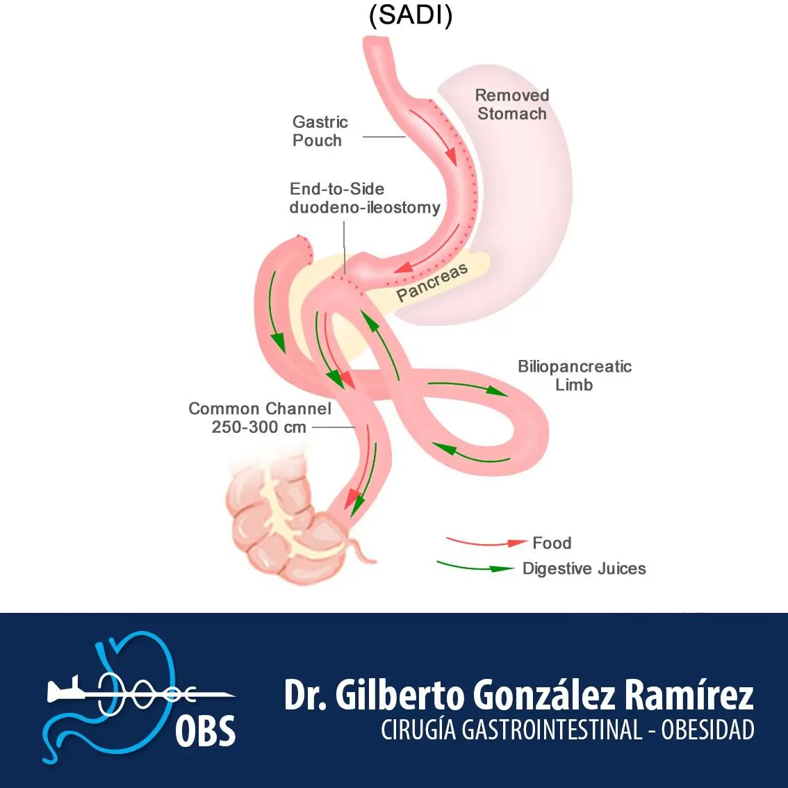 Diagrama de la cirugía SADI-S