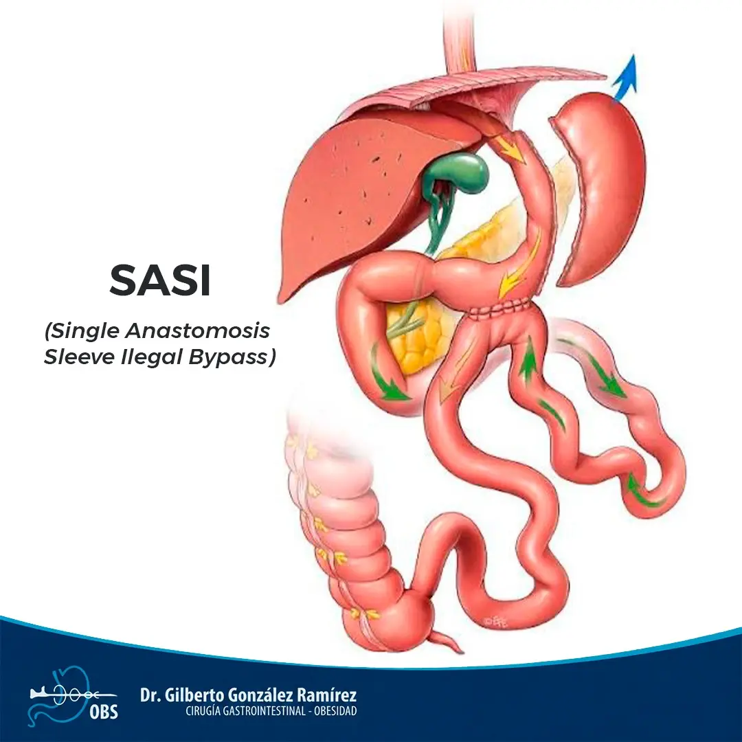 Diagrama de la cirugía SASI-S
